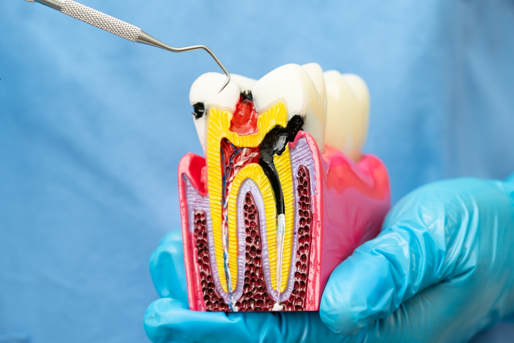 Root canal treatment oklahoma city