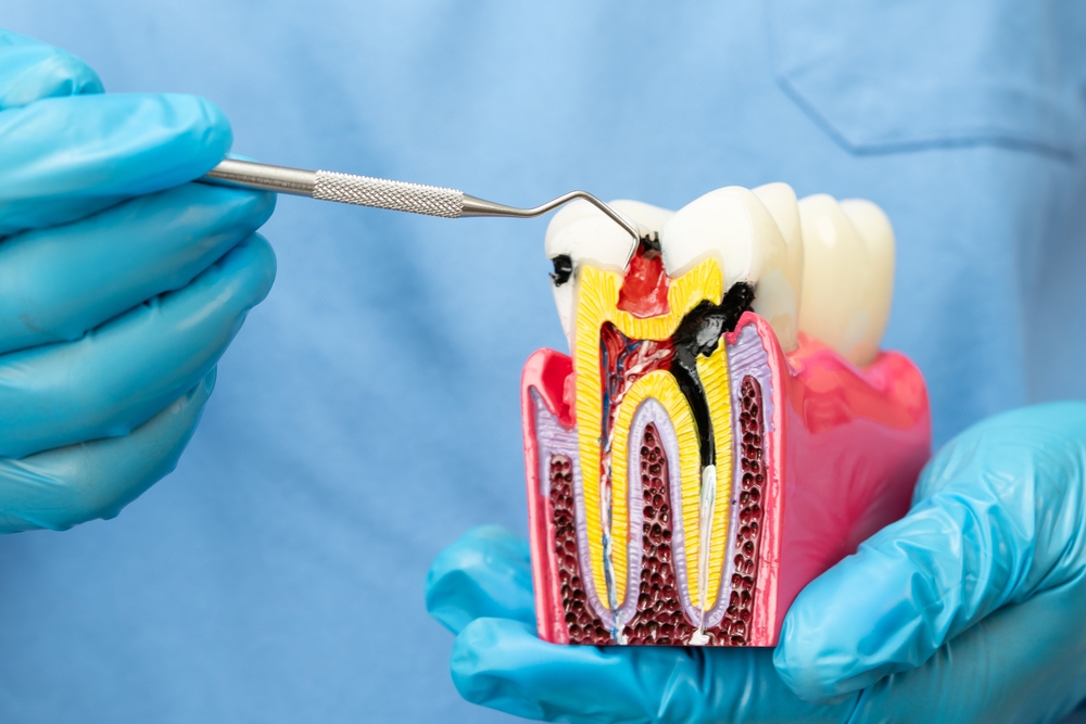 root canal oklahoma city ok