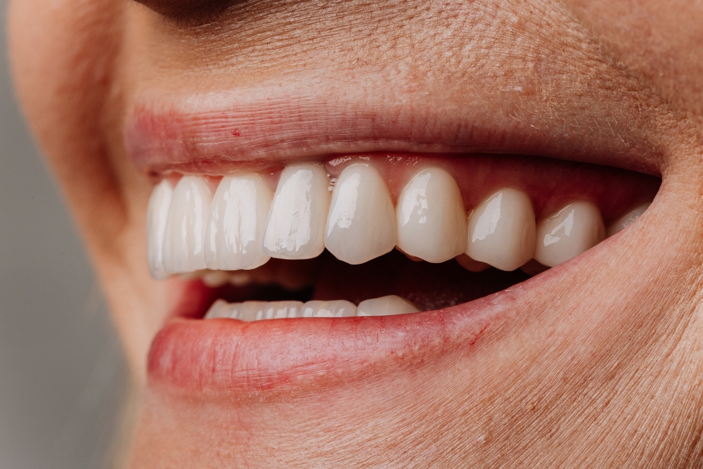 dental veneers near me